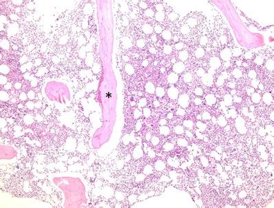 understanding bone marrow biopsy results|Demystifying the Bone Marrow Biopsy: A Hematopathology Primer.